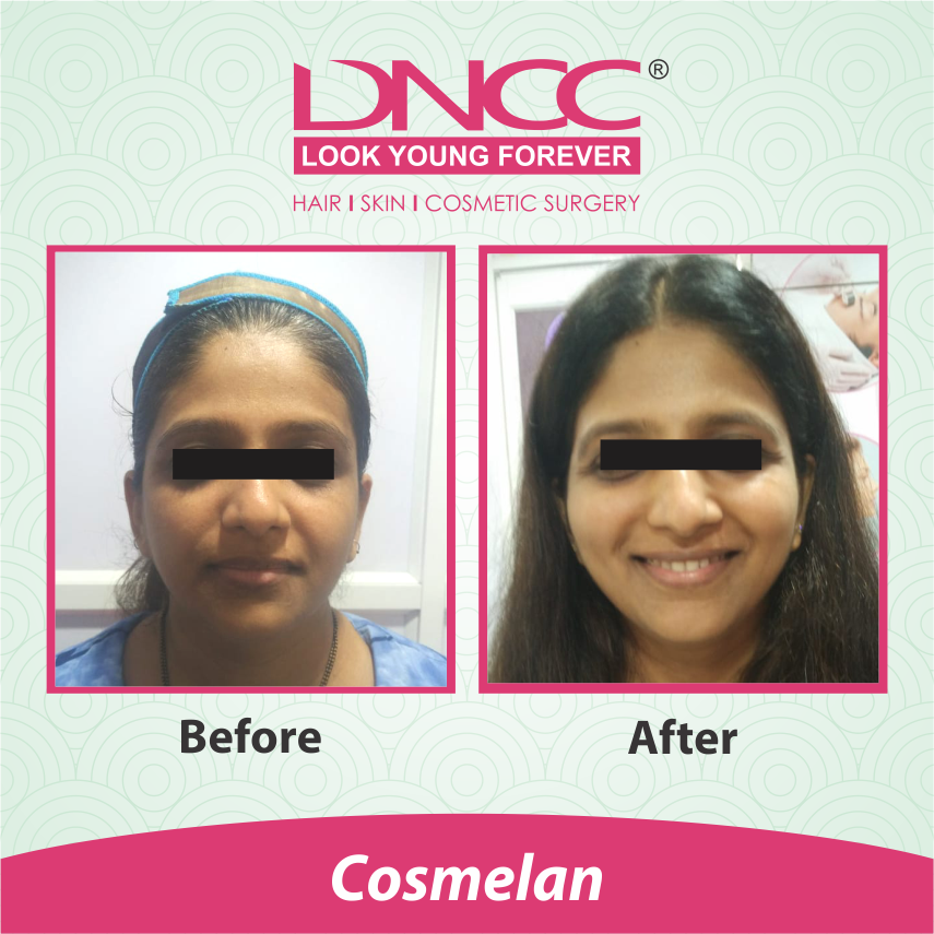 Hair Transplant Transformation 1