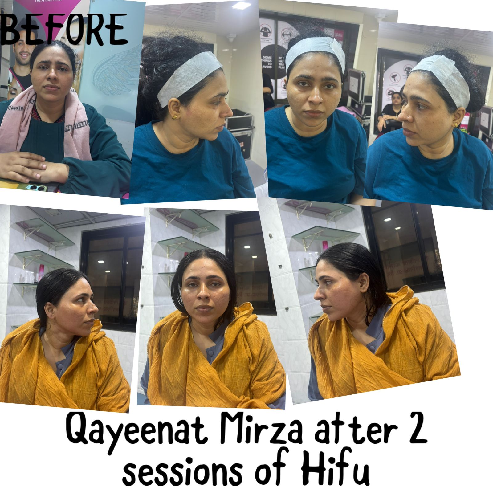 Hair Transplant Transformation 1